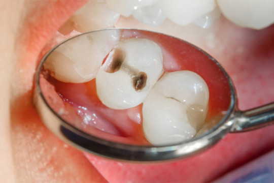 Füllungen beim Zahnarzt